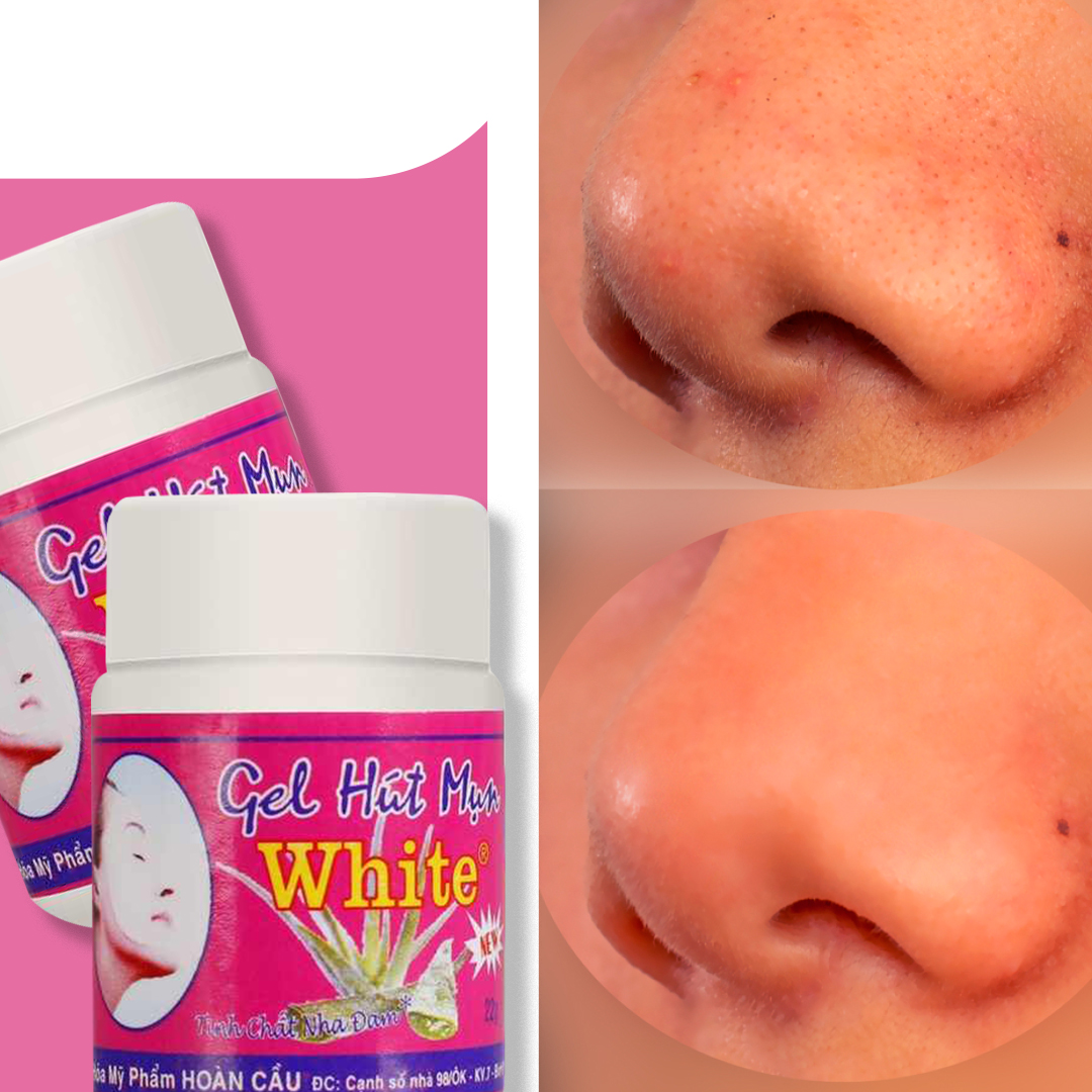 Blackhead gel Blackhead gel Beauty tools